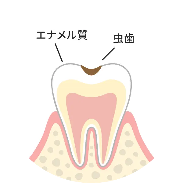 歯の表層（エナメル質）の虫歯