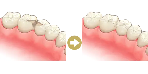 詰め物（インレー、レジン）で保護