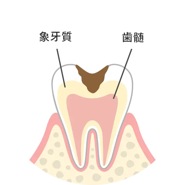 歯の中（象牙質）の虫歯