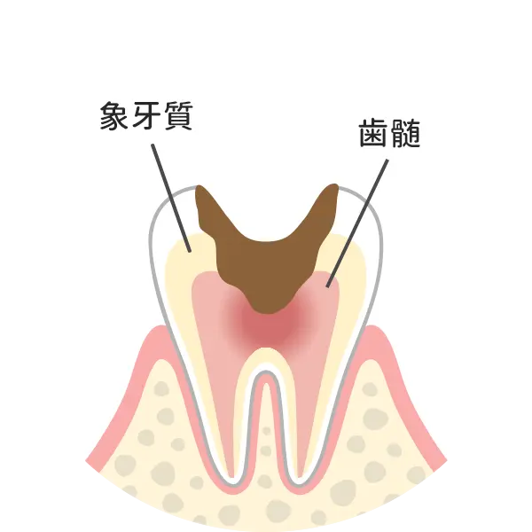 神経まで達した虫歯
