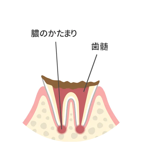 歯の根まで達した虫歯