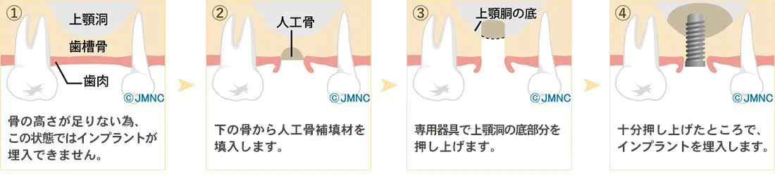 ソケットリフト法