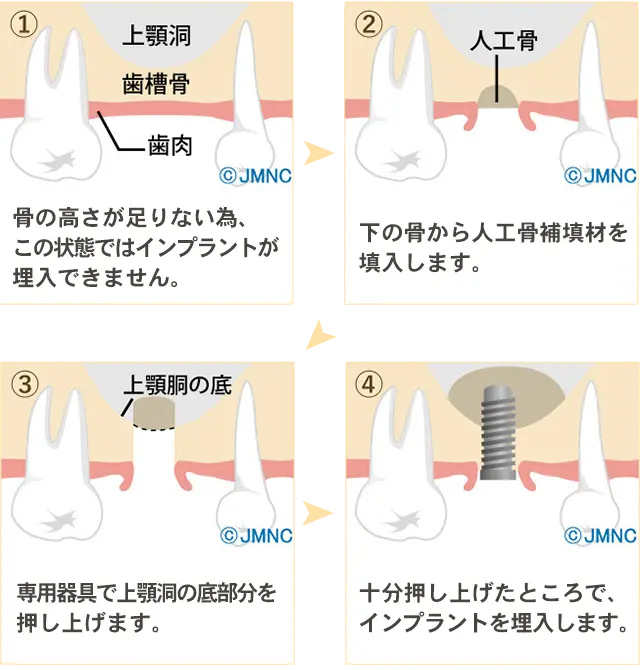 ソケットリフト法