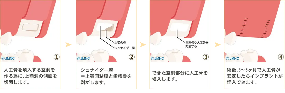 サイナスリフト法