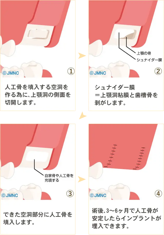サイナスリフト法