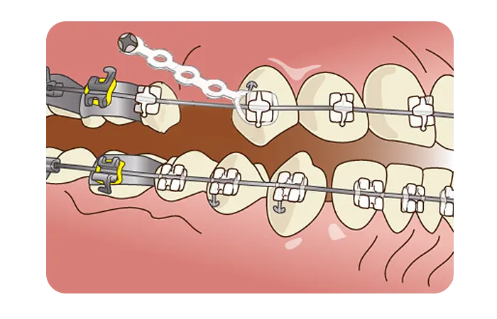 矯正用アンカースクリュー