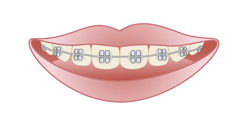 第２期矯正治療